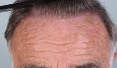 Before Hair Transplant&nbsp;Front